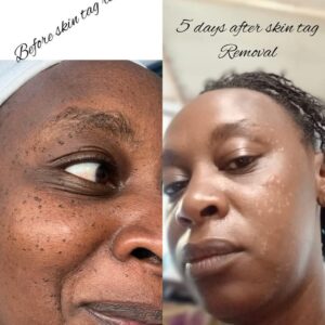 Skin Tag Removal Service