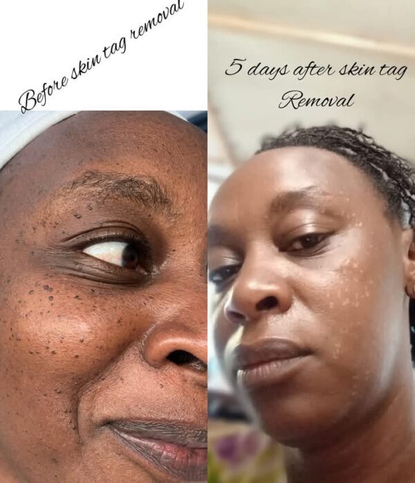 Skin Tag Removal Service